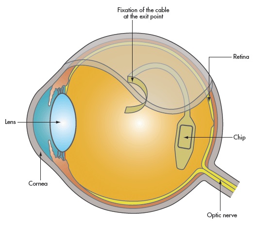 Chip implantado na retina faz o papel dos receptores de luz. Imagem: Reprodução