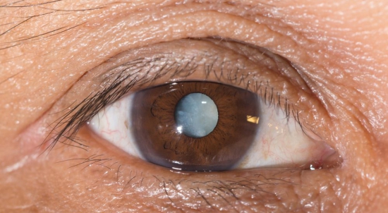 Cerca de 60% das doenças oculares que causam cegueiras são tratáveis. Imagem: Reprodução