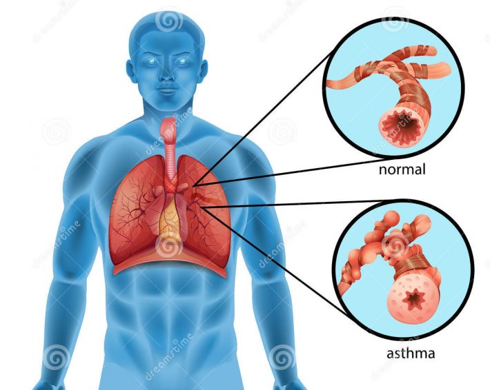 No corpo de uma pessoa que tem asma, os brônquios (tubos que levam o ar para dentro dos pulmões e o gás carbônico para fora) sofrem inflamações e se contraem, reduzindo o espaço da passagem. Imagem: DreamsTime